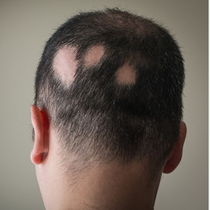 Alopecia Areata and Treatment
