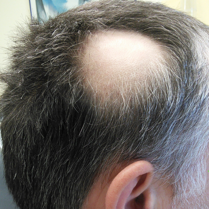 Is Alopecia Areata Hereditary ?