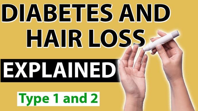 Can Diabetes Cause Hair Loss ? Everything You Need to Know About it!
